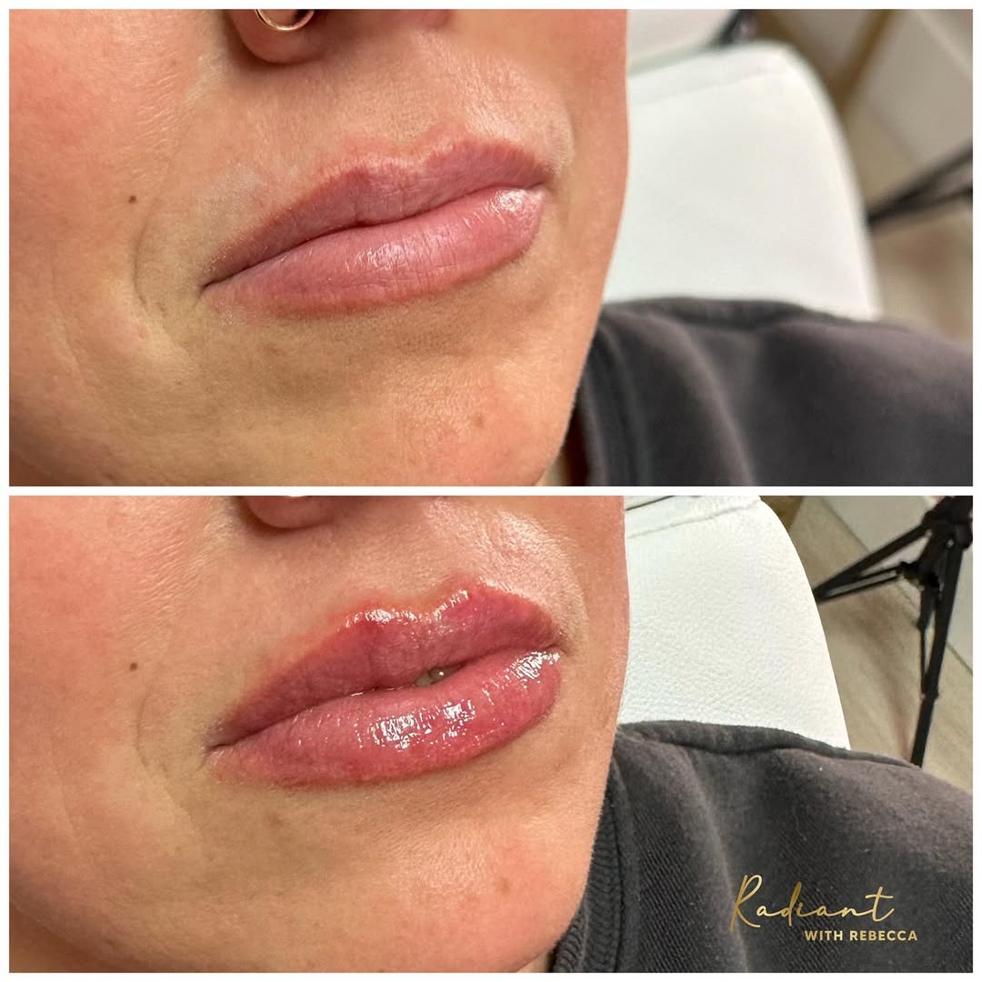 Natural Lip Enhancement result